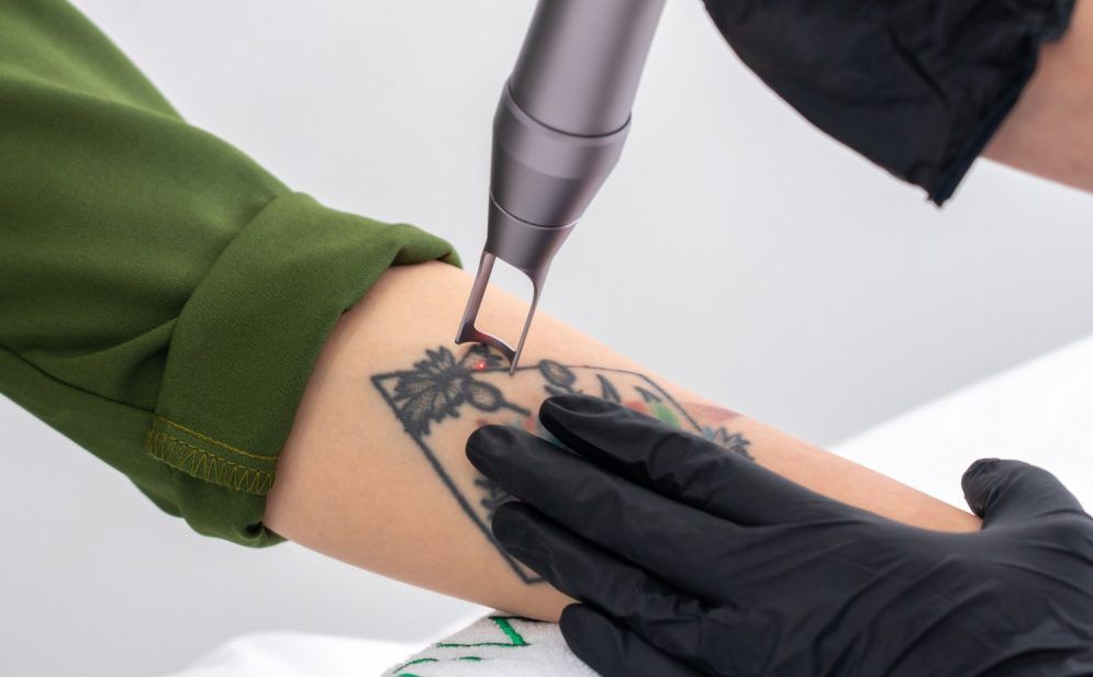 Laserowe usuwanie tatuażu blisko Ciebie