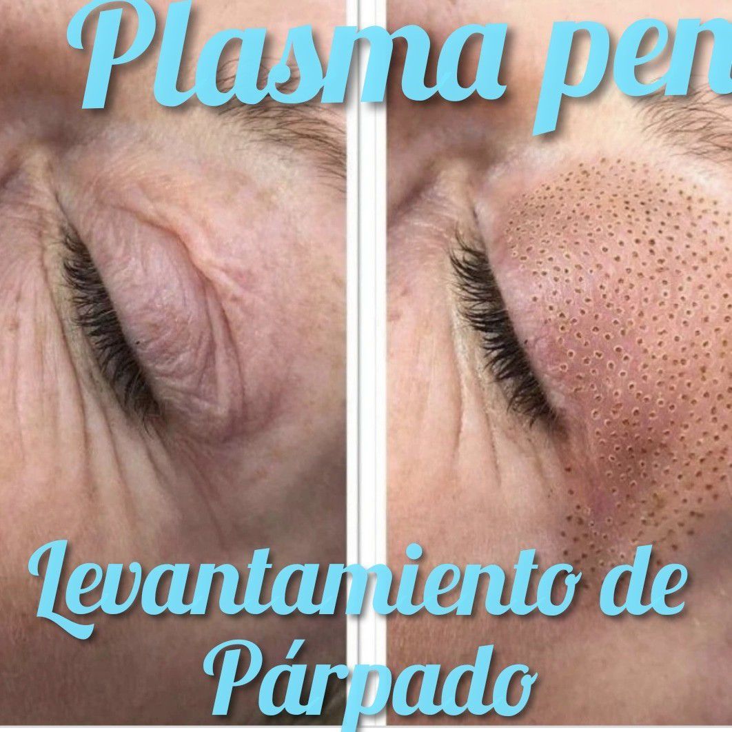 Tratamiento con Plasma Pen Verrugas Lunares, Manch portfolio