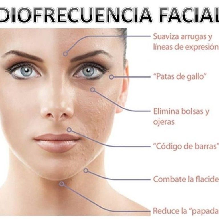 Radiofrecuencia Facial portfolio