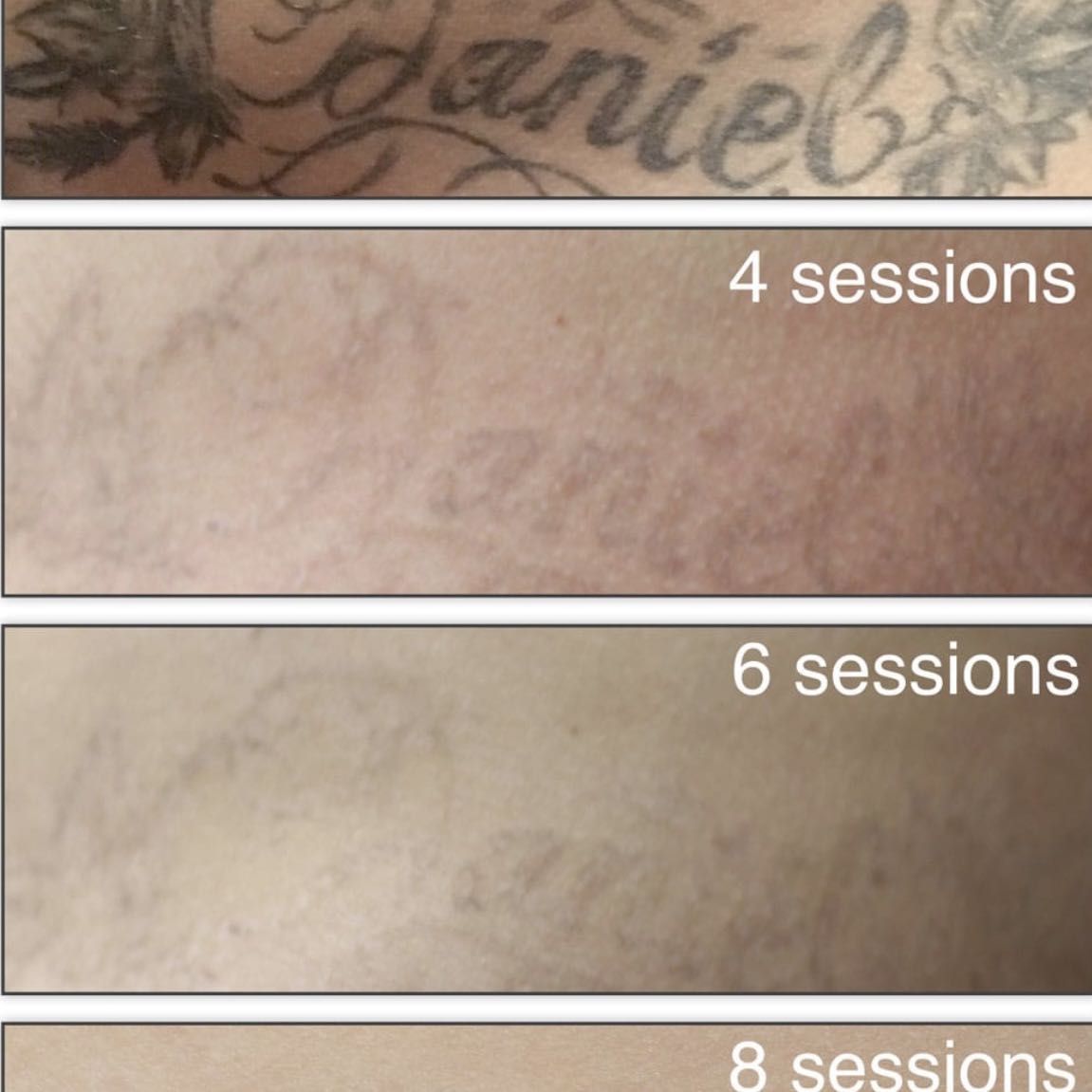Eliminación de tatuaje XL ( desde 30cm ) portfolio