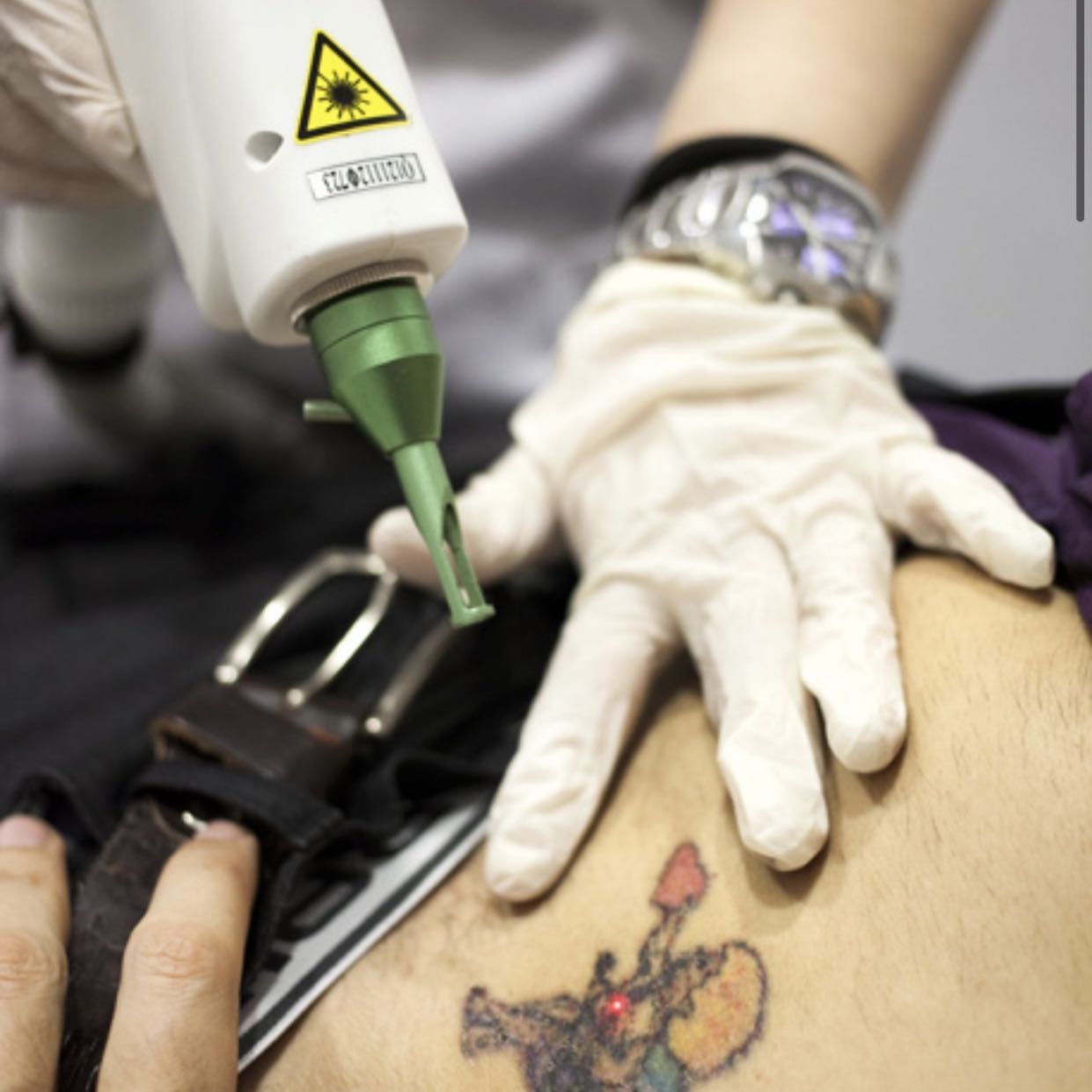 Eliminación de tatuaje mediano (8-15cm) portfolio