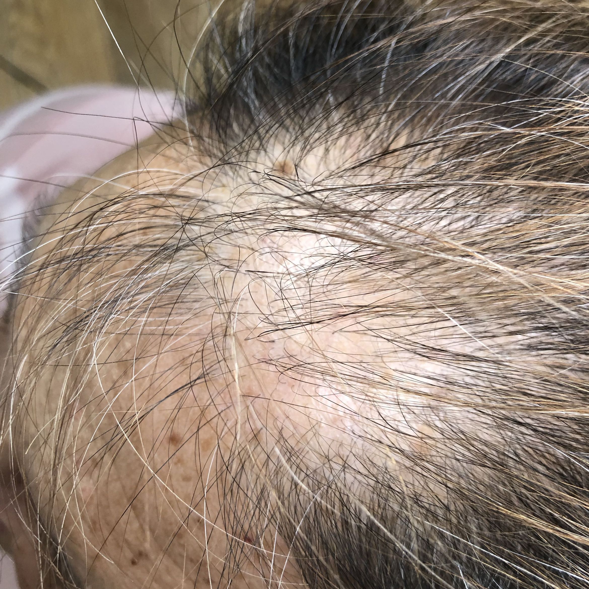 Tratamiento medico para la alopecia portfolio