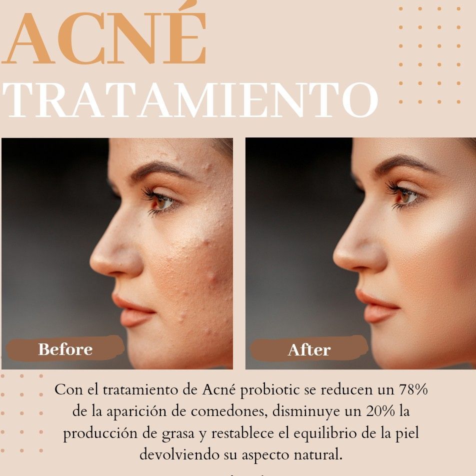 Tratamiento Facial Anti Acné portfolio