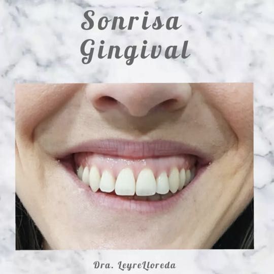 SONRISA GINGIVAL portfolio