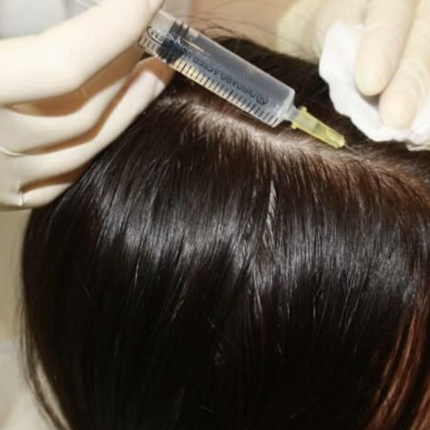 Porfolio de Mésothérapie Cheveux Dr. Cyj HAIR FILLER