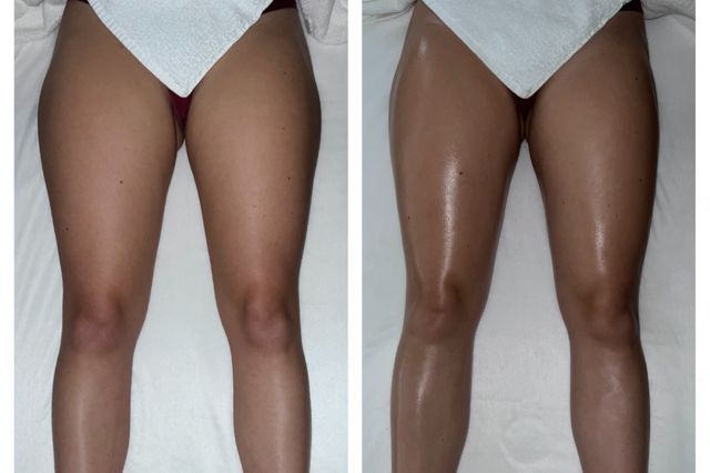 Porfolio de Drainage lymphatique jambes Renata