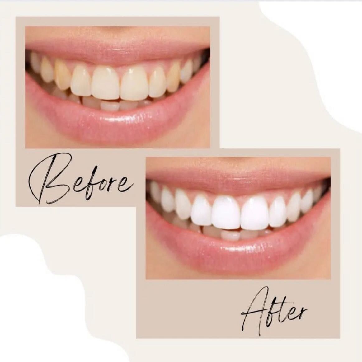 Laser Teeth Whitening 1 hour portfolio
