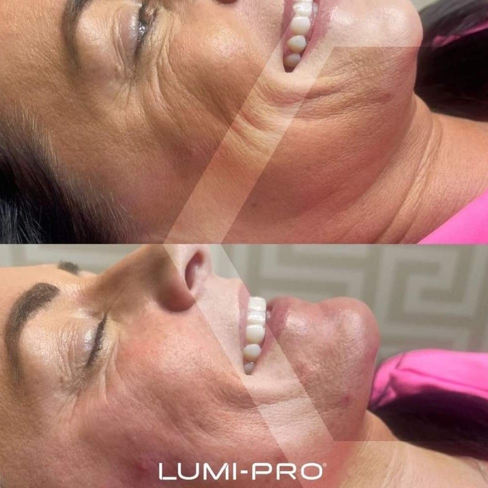 Lumi-Pro Skin Booster SPECIAL portfolio