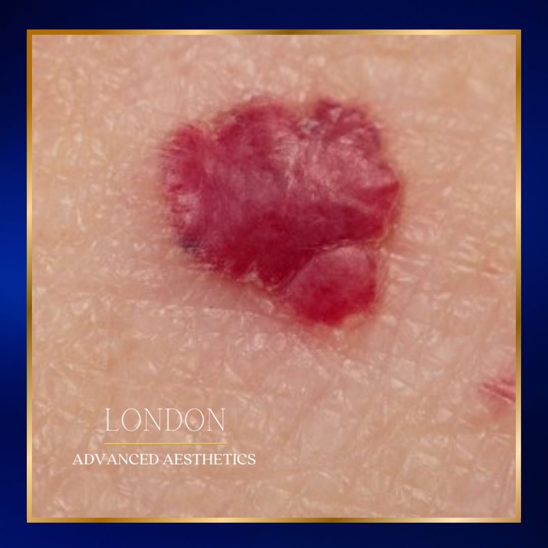 Consultation - Skin Lesion Removal portfolio