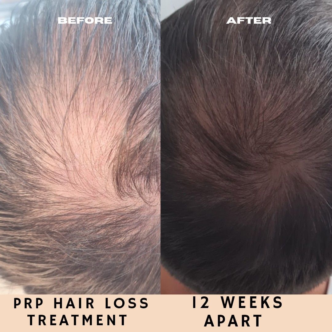 Prp hair treatment, half a head portfolio