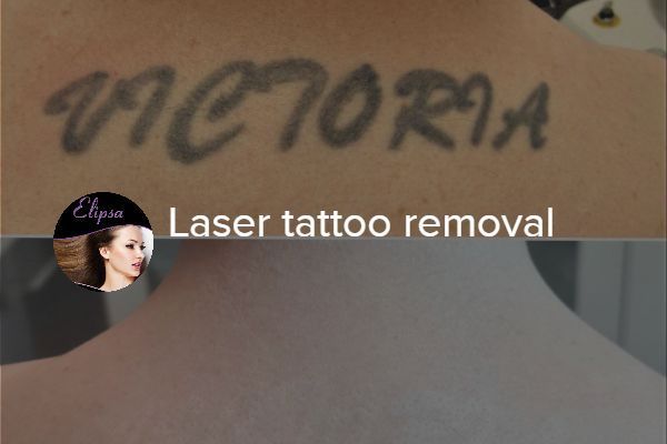 Laser Tattoo Removal Q Switched Nd YAG portfolio