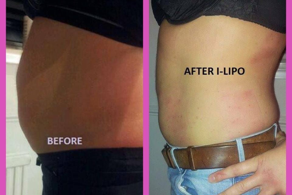 I-lipo the laser liposuction portfolio