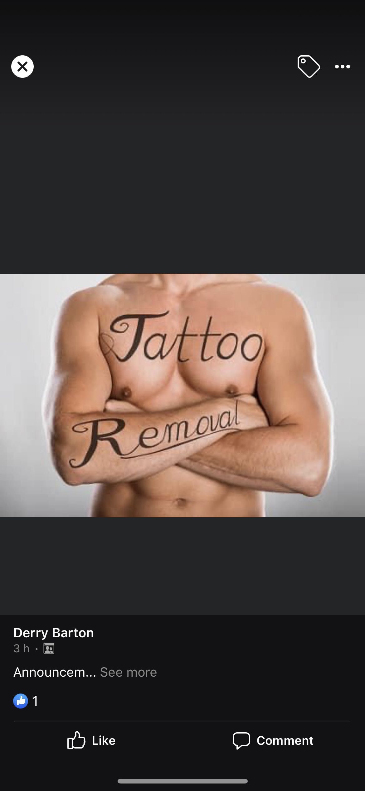 Tattoo Removal portfolio