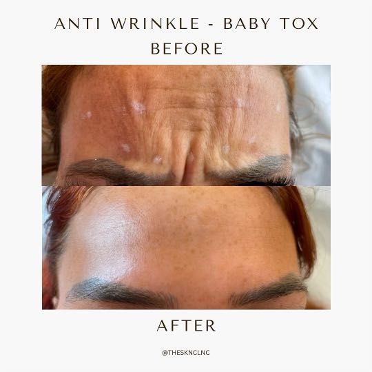 Botox/Anti wrinkle injections portfolio