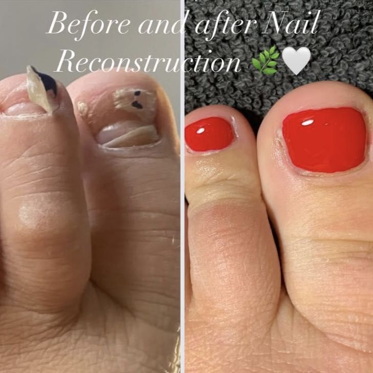 LCN Nail Reconstruction (per nail) portfolio
