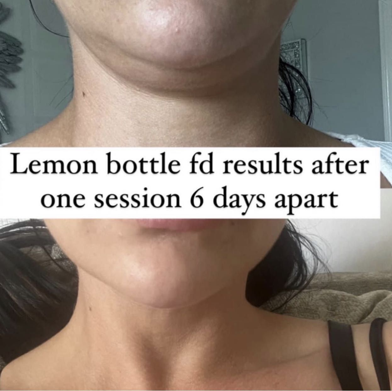Lemon Bottle Fat Dissolving Chin portfolio