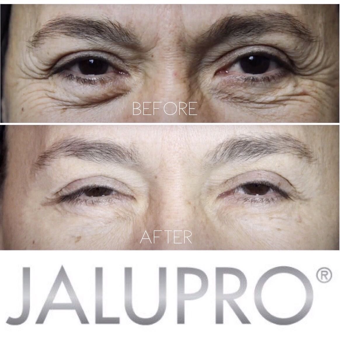 Jalupro eye skin boosters portfolio