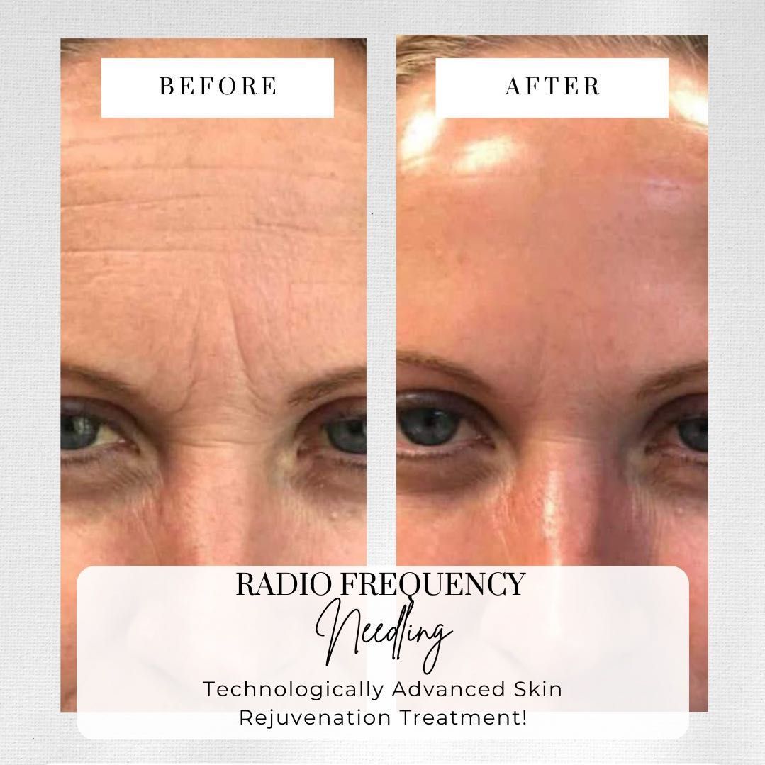 Radio frequency microneedle facial anti aging/scar portfolio