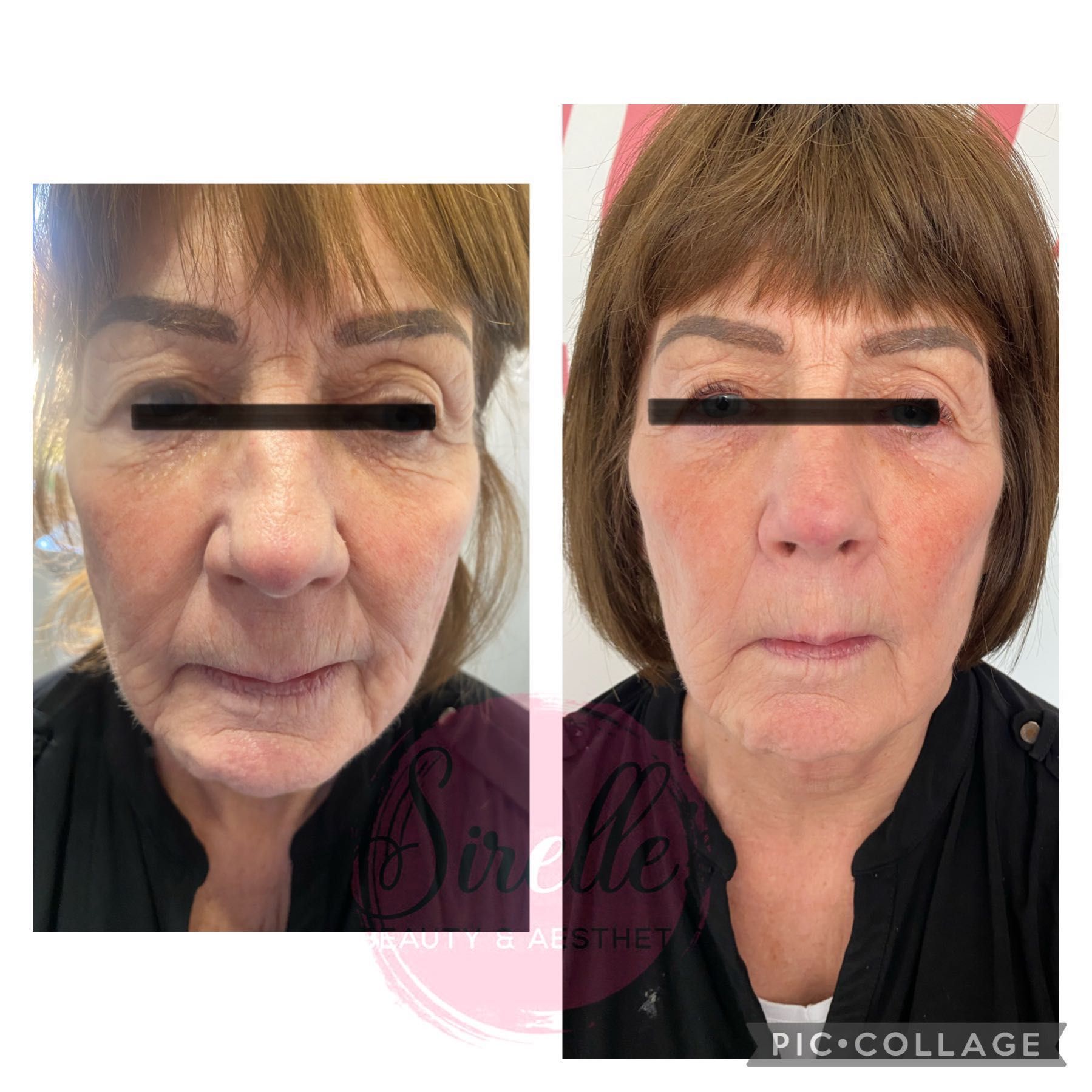 8 POINT HOLLYWOOD FACE LIFT normally £350 portfolio