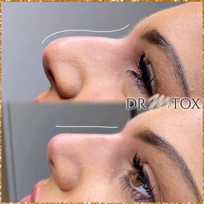 Non-Surgical Nose Job (Add on to Package) portfolio