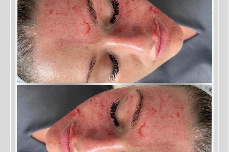 PRP Vampire Facial - Skin Needling portfolio