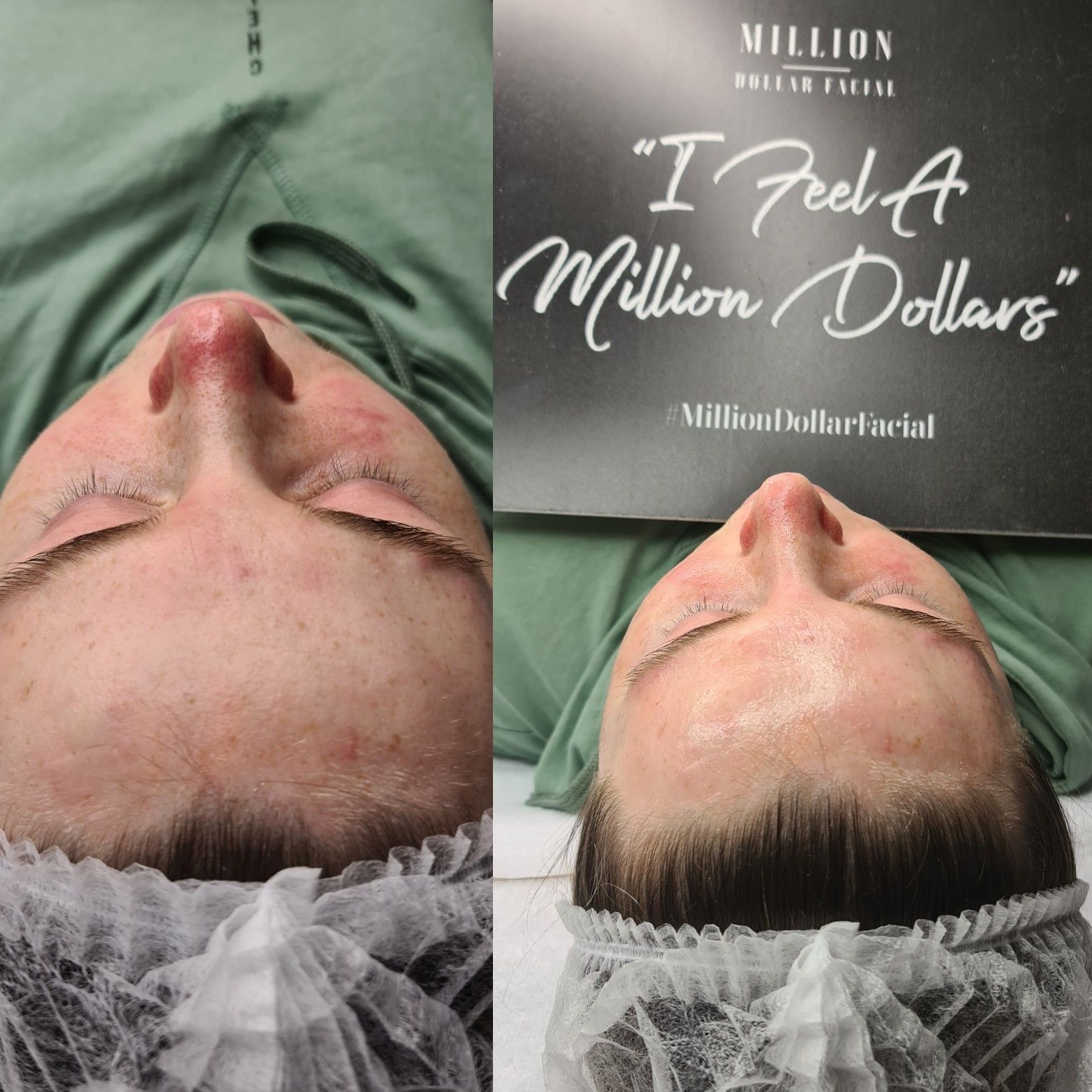 Mini Million Dollar Facial portfolio