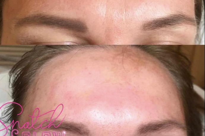 Botox (3 areas) Forehead Full Freeze portfolio