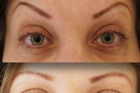 Botox Correction (New Clients from Elsewhere) portfolio