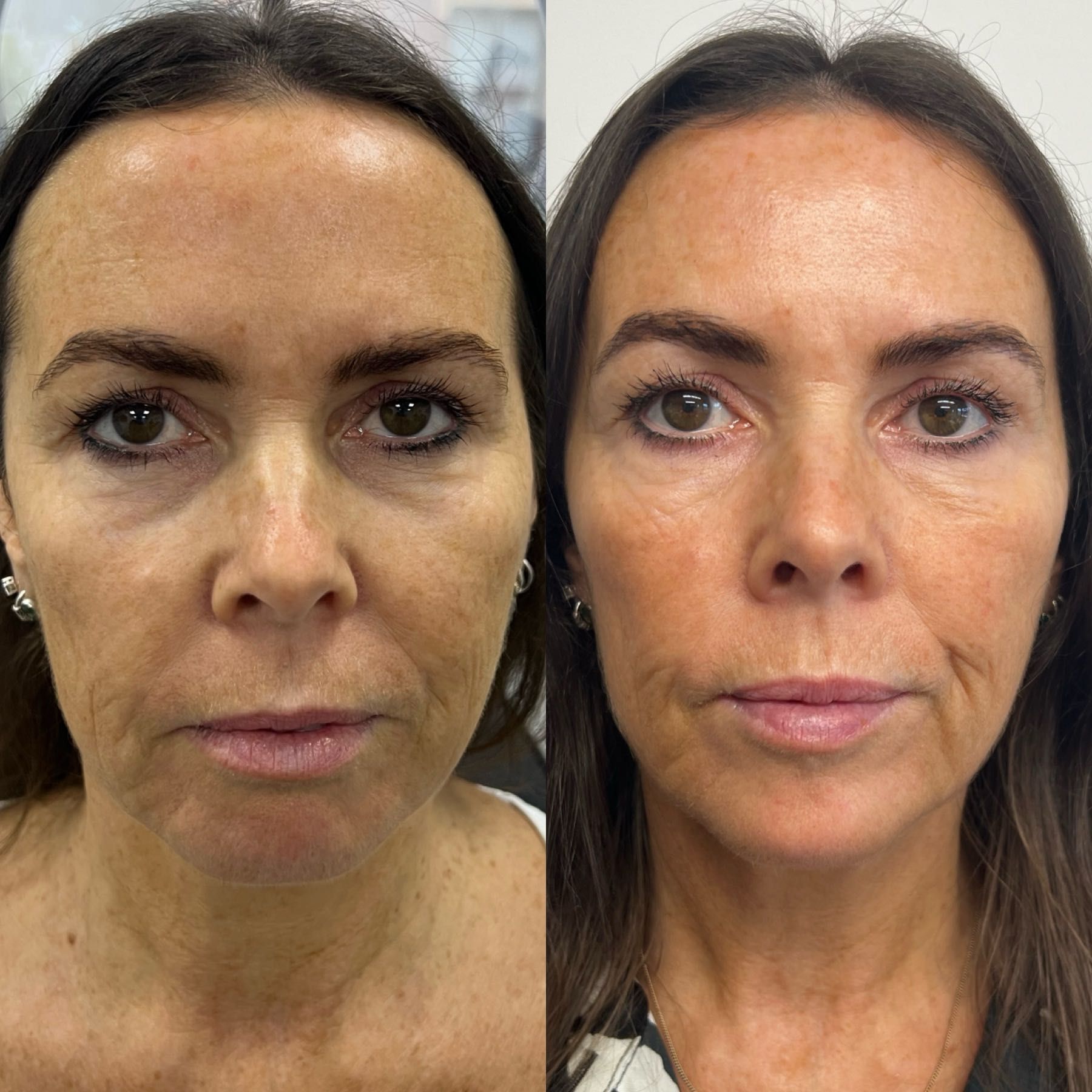 Botox full face and neck lift portfolio