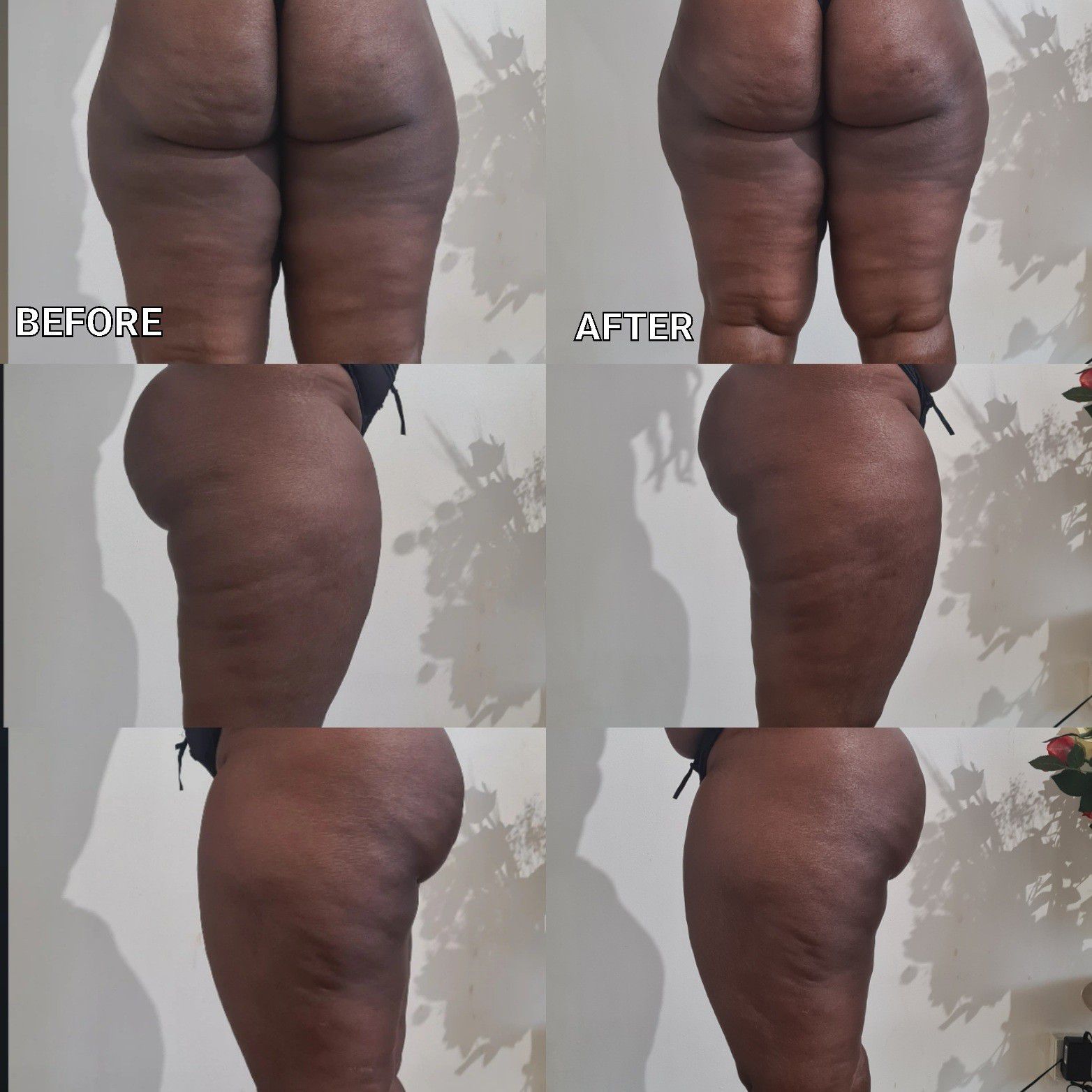 6 Cellulite Reduction (Thighs) portfolio