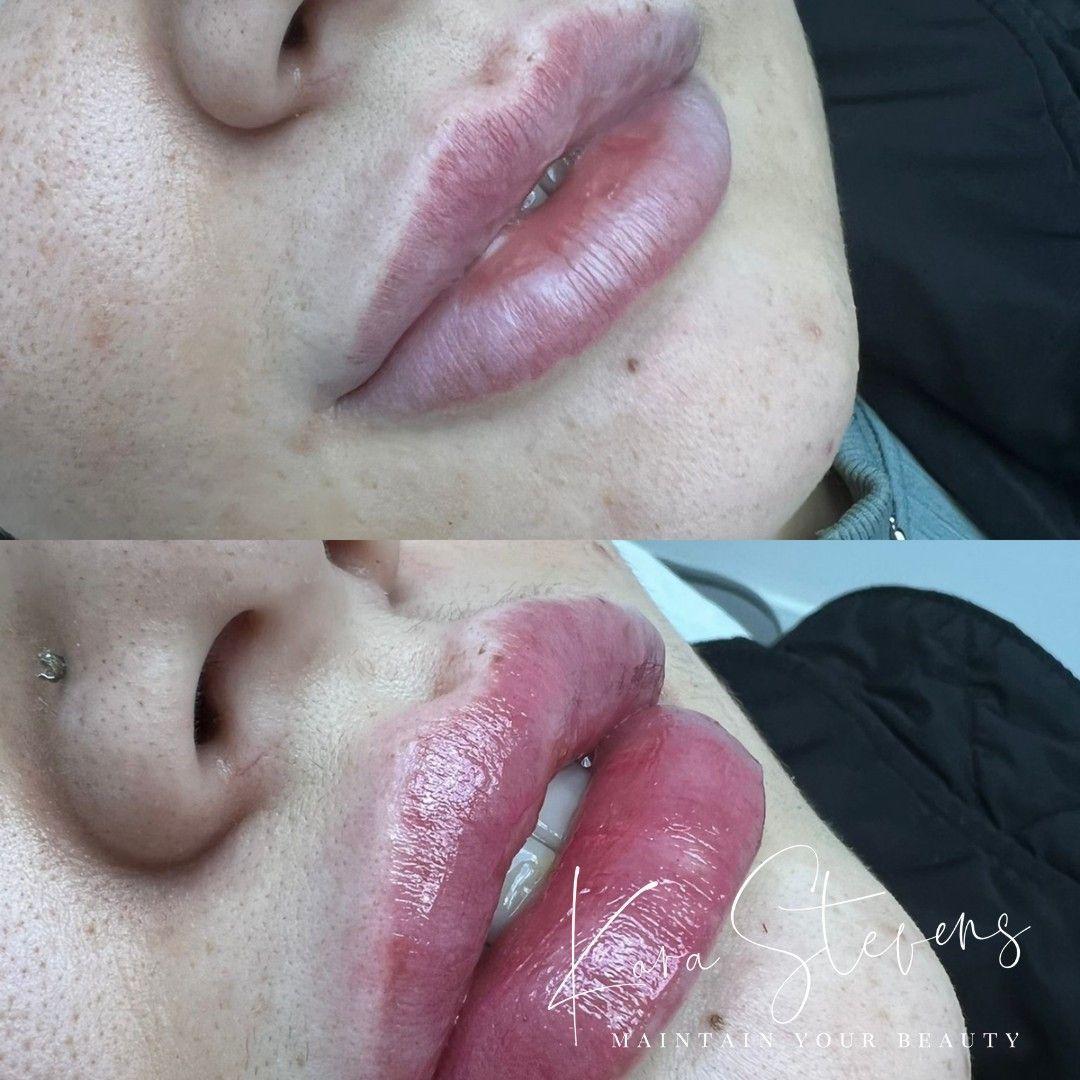 Dermal Filler - Lips - 1ml portfolio