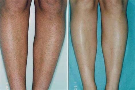 Laser hair removal- Full Legs portfolio