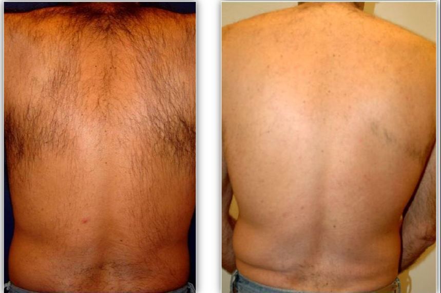 Laser hair removal-Upper Back portfolio