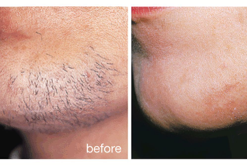 Laser hair removal- Upper Lip & Chin portfolio