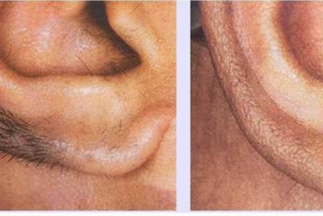 Laser hair removal Nose and Ear lobes portfolio