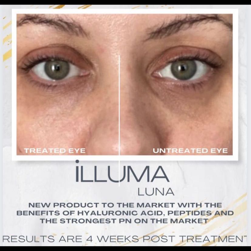 illuma Luna Undereye skin booster portfolio
