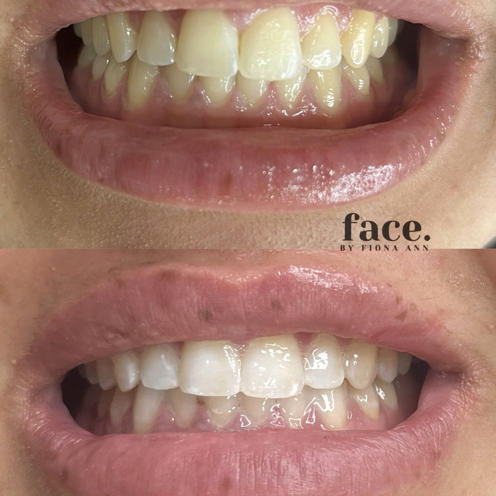 Teeth Whitening portfolio