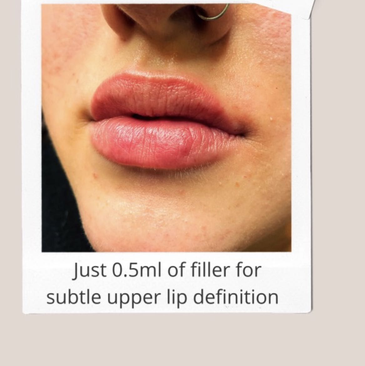 Mini Lip Enhancement (0.5ml) portfolio
