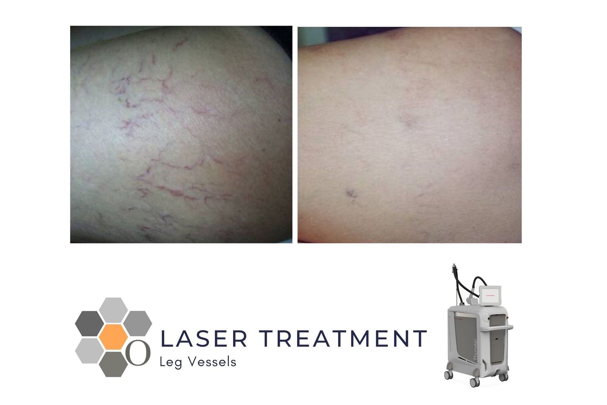 Thread Vein Laser Treatment - Leg Vessels portfolio
