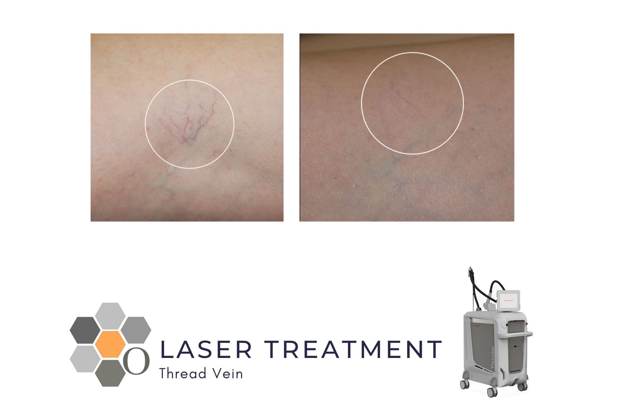 Thread Vein Laser Treatment - Leg Vessels portfolio