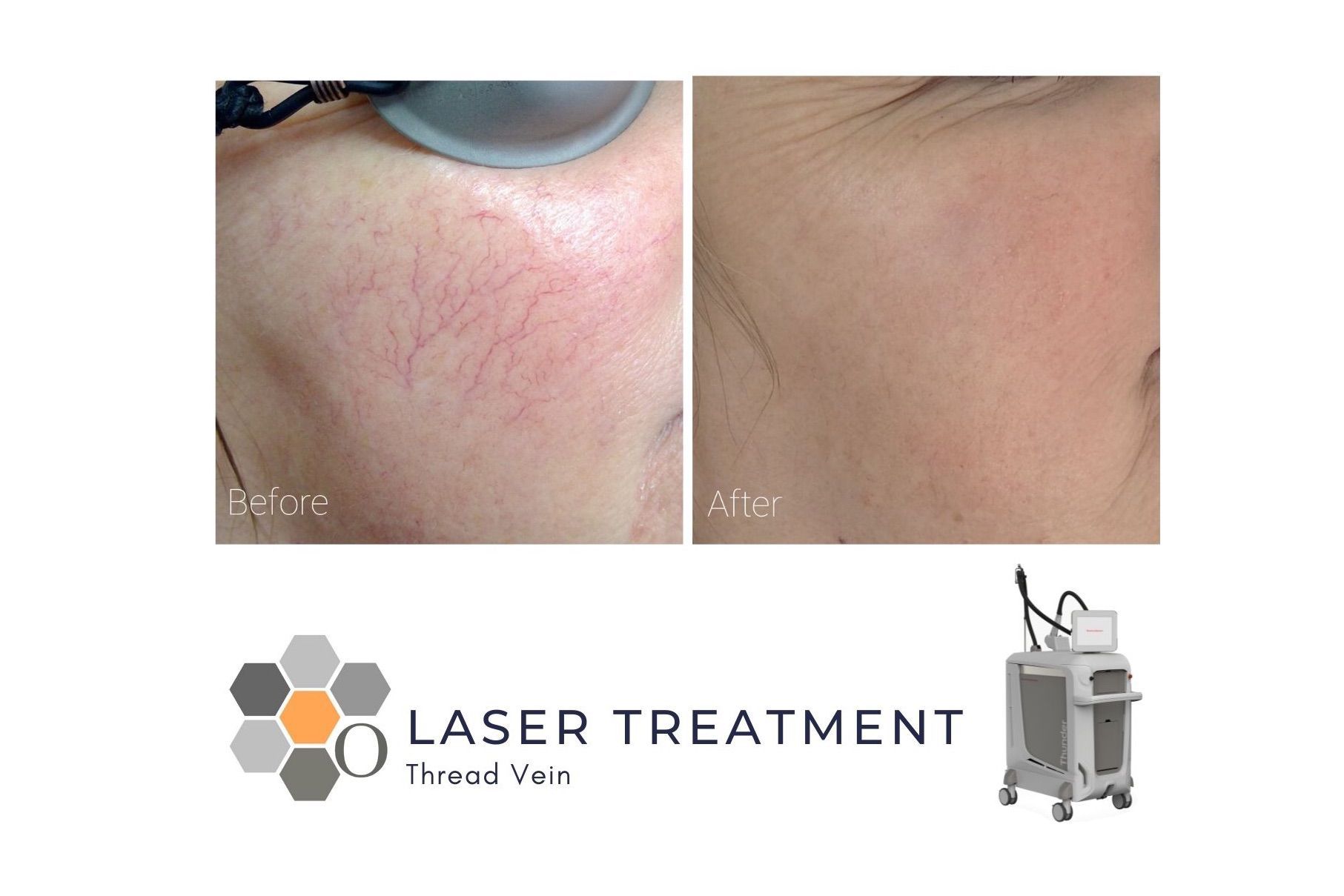 Thread Vein Laser Treatment - Cheeks and Nose portfolio