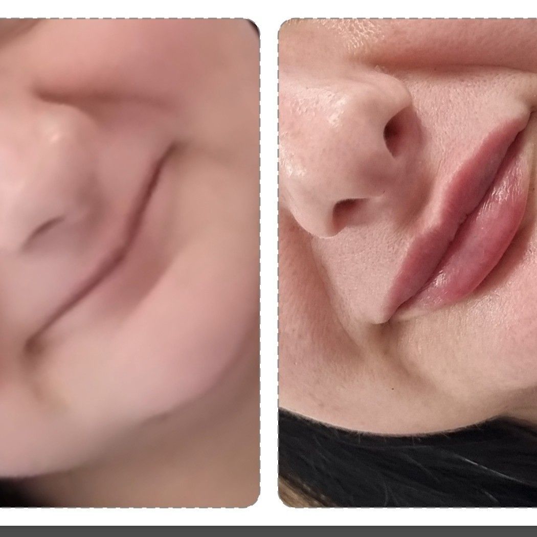 Fillers Lips- Correction Of Lips After Other Salon portfolio