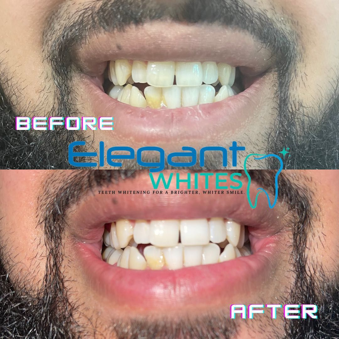Elegant Whites Laser Teeth Whitening portfolio