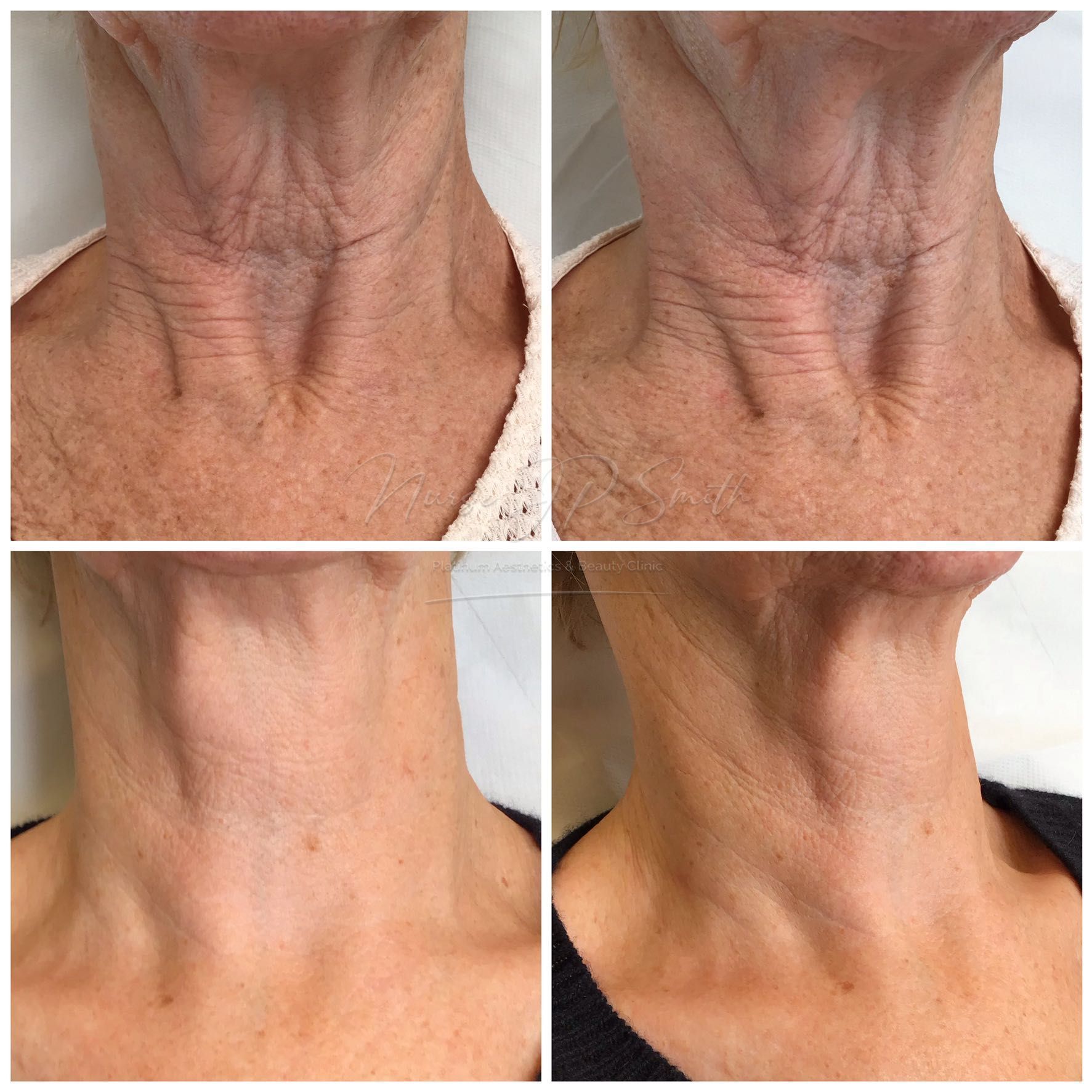 PROFHILO-collagen/elastin/moisture-(face or neck) portfolio