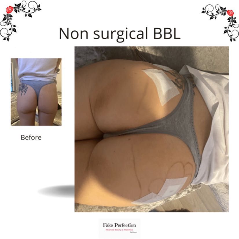 Non surgical BBL (Bum filler) 20ml portfolio