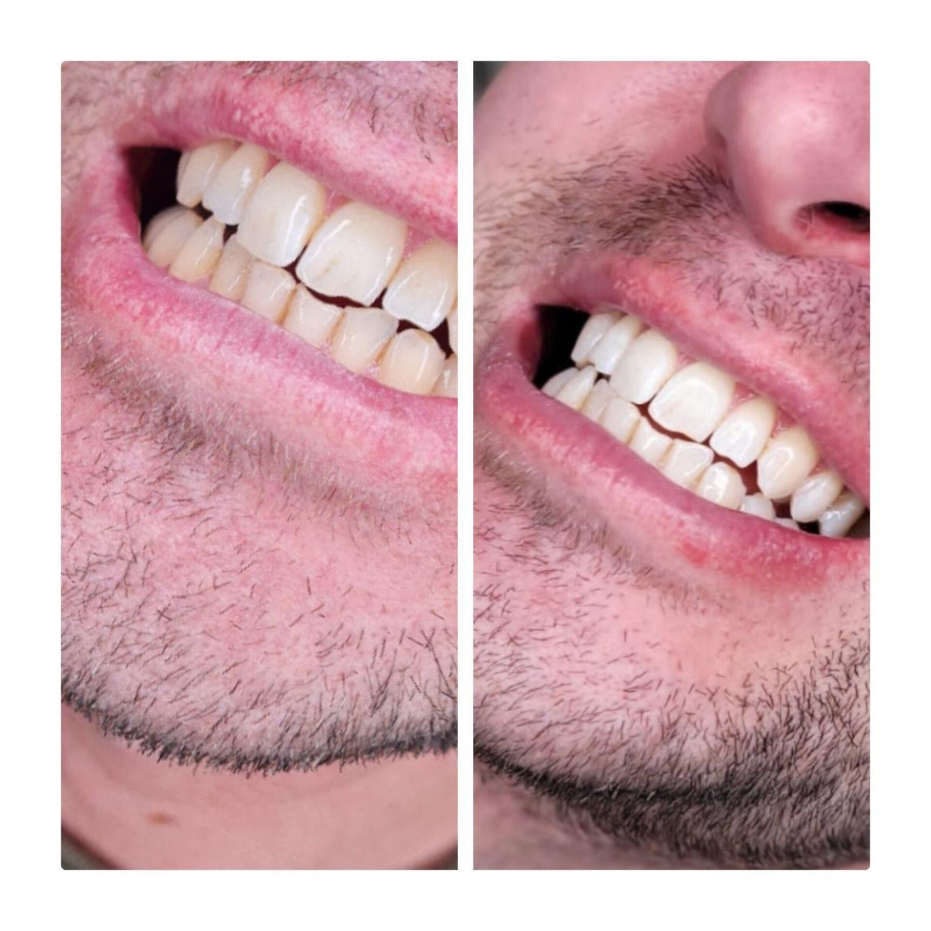 Teeth Whitenning 15 Minutes (+15 min. free) portfolio