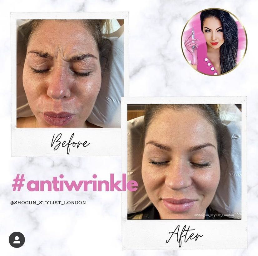 Frozen Anti-Wrinkle Treatment full Face 💉 portfolio
