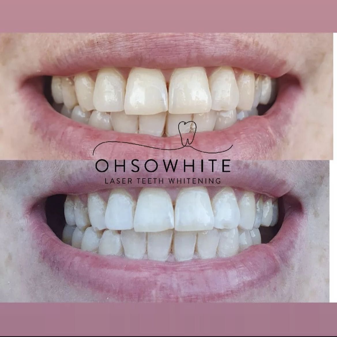 Cosmetic teeth whitening portfolio