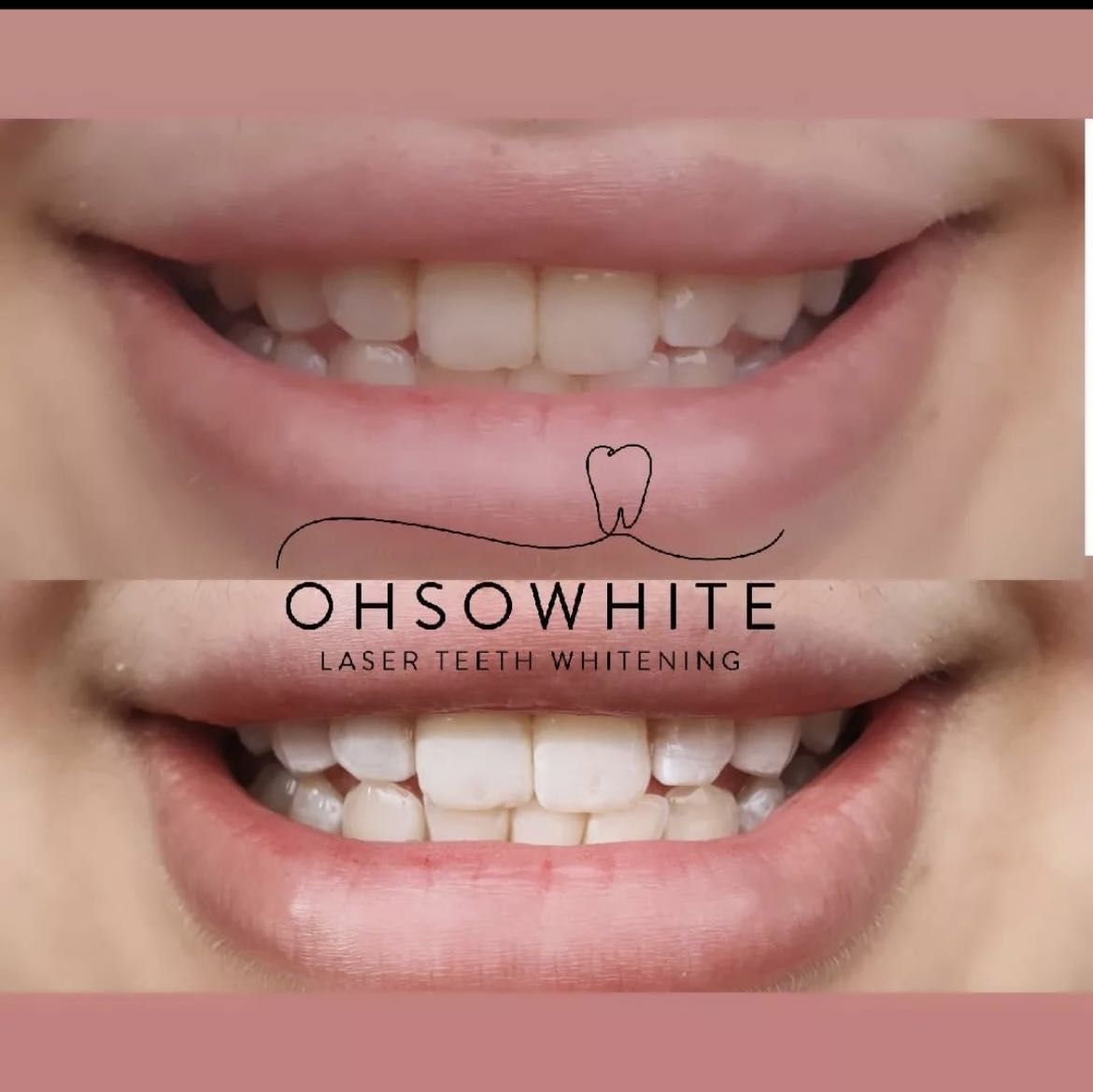 Cosmetic teeth whitening portfolio