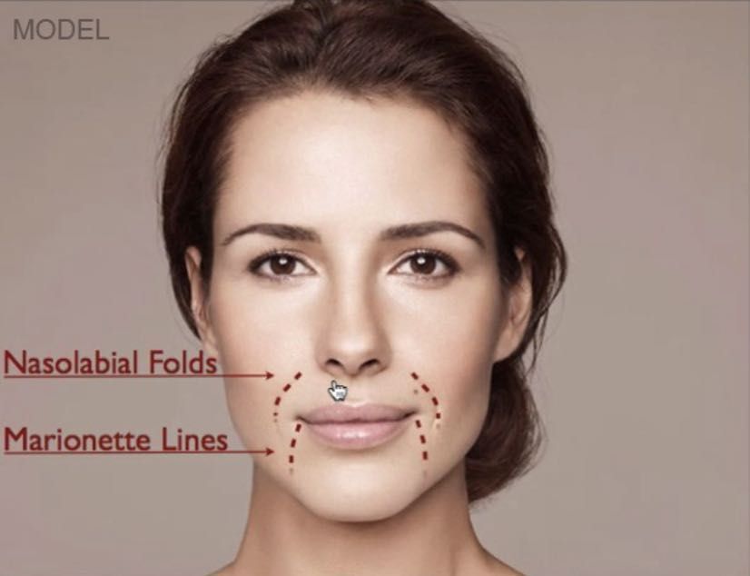 Nose to mouth lines (Nasolabial folds) 1.1ml portfolio